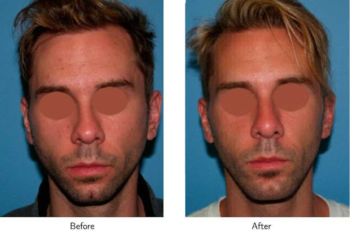 Chin Augmentation Before & After Gallery - Patient 64081141 - Image 3
