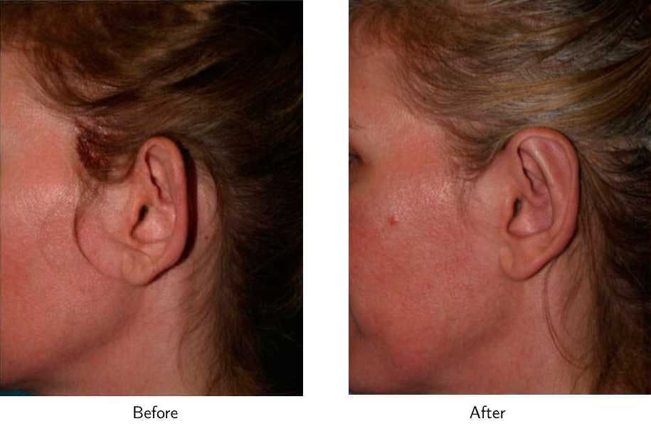 Ear Pinning (Otoplasty) Before & After Gallery - Patient 64081142 - Image 2