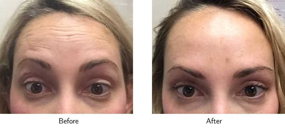 Wrinkle Treatments Before & After Gallery - Patient 64081143 - Image 1
