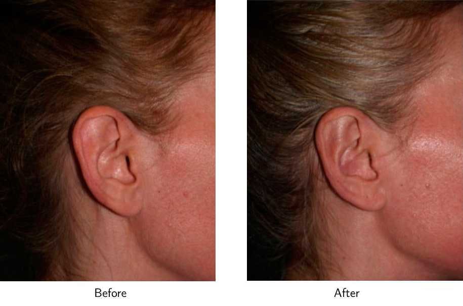 Ear Pinning (Otoplasty) Before & After Gallery - Patient 64081142 - Image 3