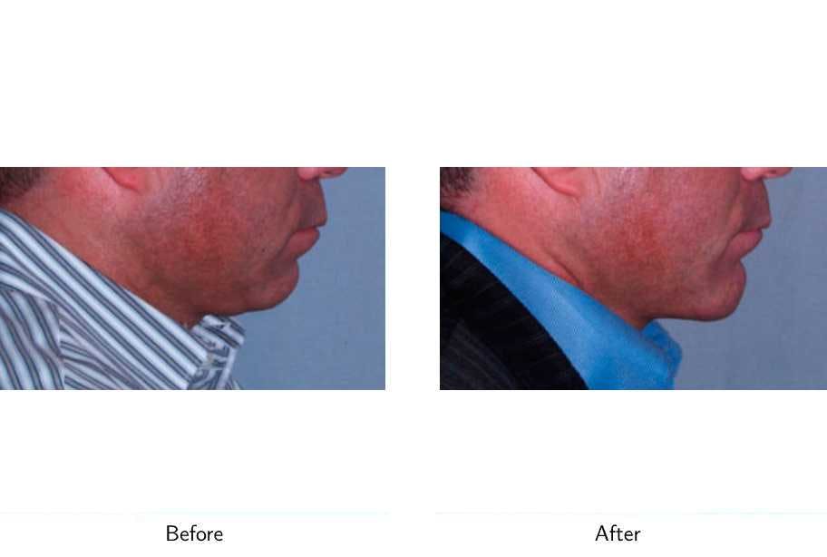 Chin Augmentation Before & After Gallery - Patient 64081144 - Image 2