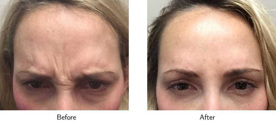 Wrinkle Treatments Before & After Gallery - Patient 64081143 - Image 2