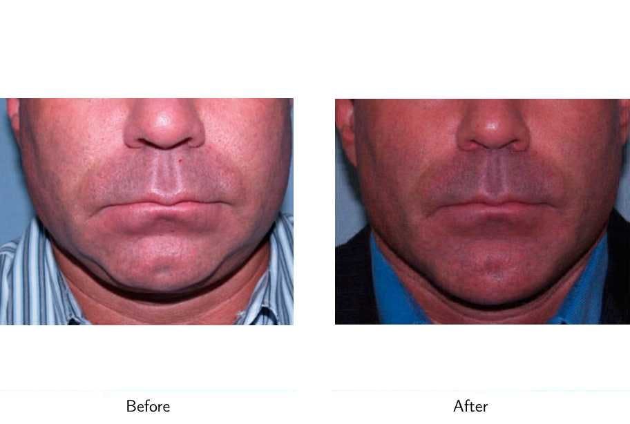 Chin Augmentation Before & After Gallery - Patient 64081144 - Image 1