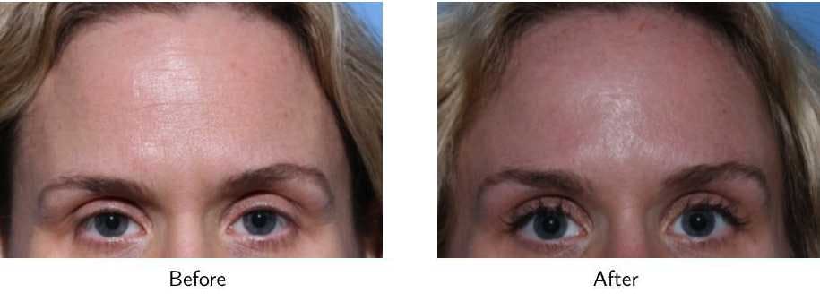 Wrinkle Treatments Before & After Gallery - Patient 64081147 - Image 1