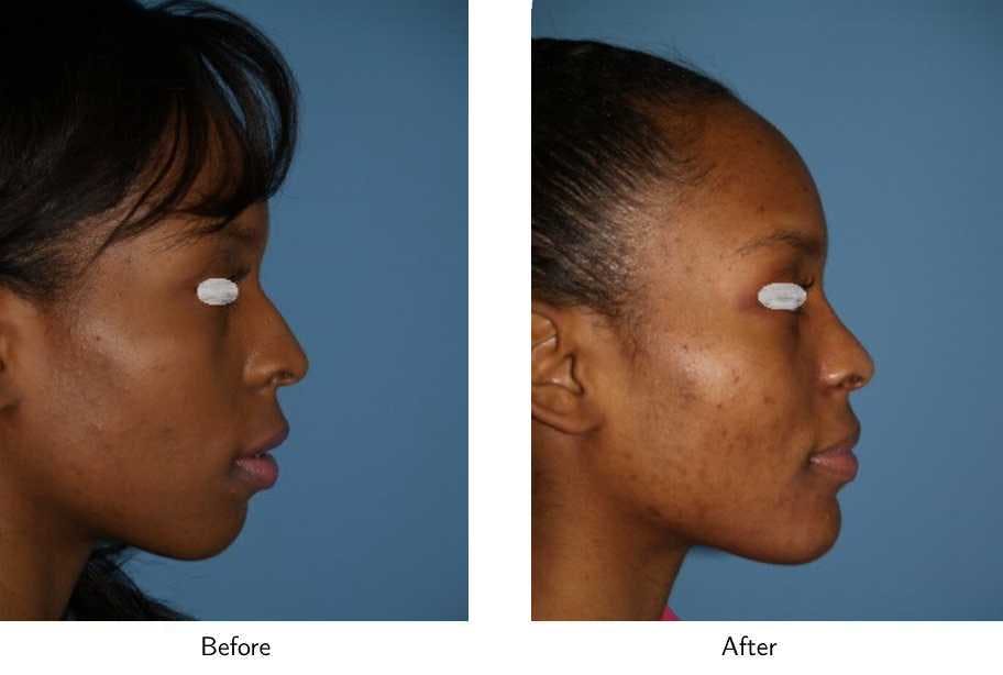 Chin Augmentation Before & After Gallery - Patient 64081146 - Image 1