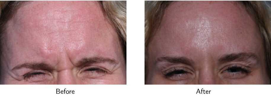 Wrinkle Treatments Before & After Gallery - Patient 64081147 - Image 2