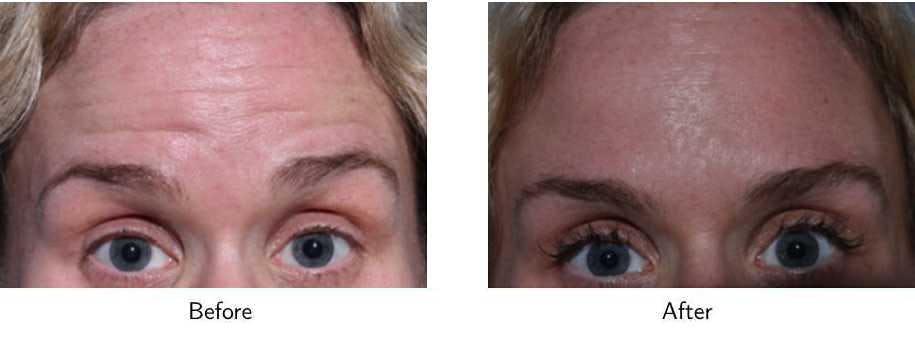 Wrinkle Treatments Before & After Gallery - Patient 64081147 - Image 3