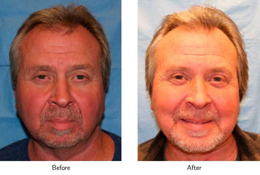 Chin Augmentation Before & After Gallery - Patient 64081151 - Image 1