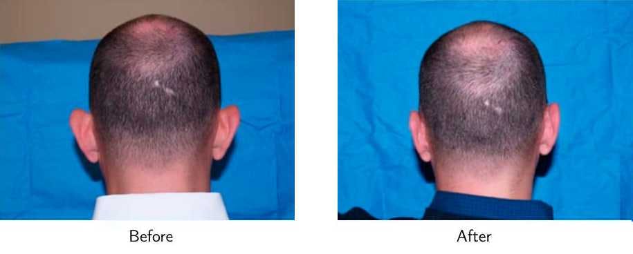 Ear Pinning (Otoplasty) Before & After Gallery - Patient 64081148 - Image 2