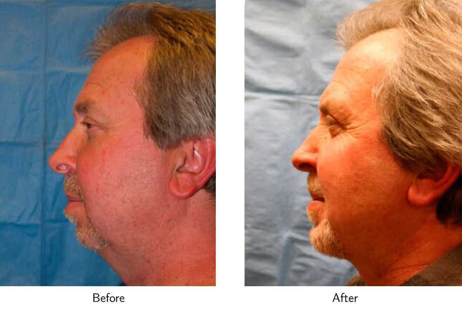 Chin Augmentation Before & After Gallery - Patient 64081151 - Image 2