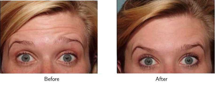 Wrinkle Treatments Before & After Gallery - Patient 64081152 - Image 1