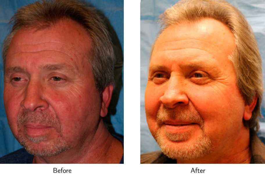 Chin Augmentation Before & After Gallery - Patient 64081151 - Image 3