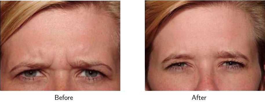 Wrinkle Treatments Before & After Gallery - Patient 64081152 - Image 2