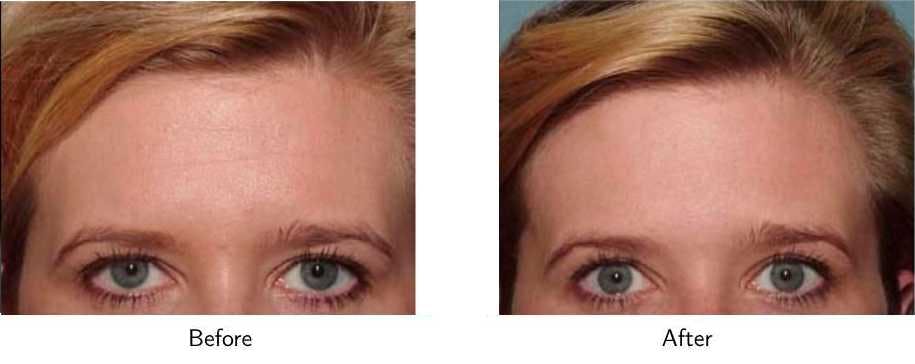 Wrinkle Treatments Before & After Gallery - Patient 64081152 - Image 3