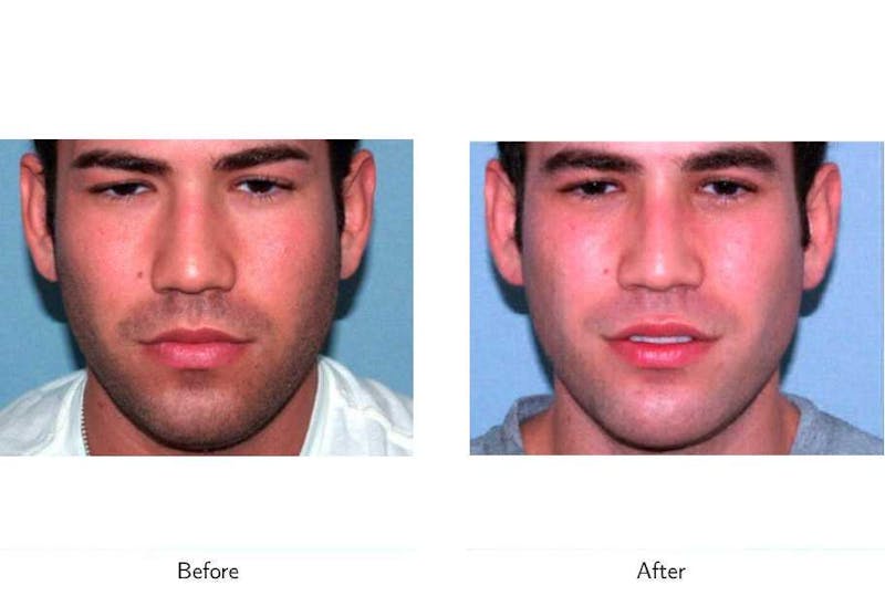 Chin Augmentation Before & After Gallery - Patient 64081154 - Image 1