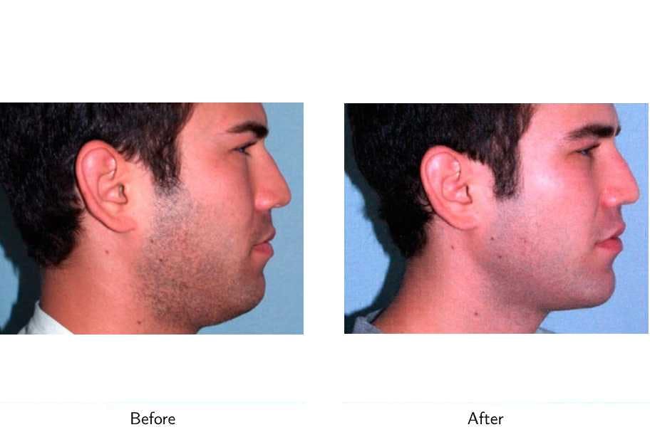 Chin Augmentation Before & After Gallery - Patient 64081154 - Image 2