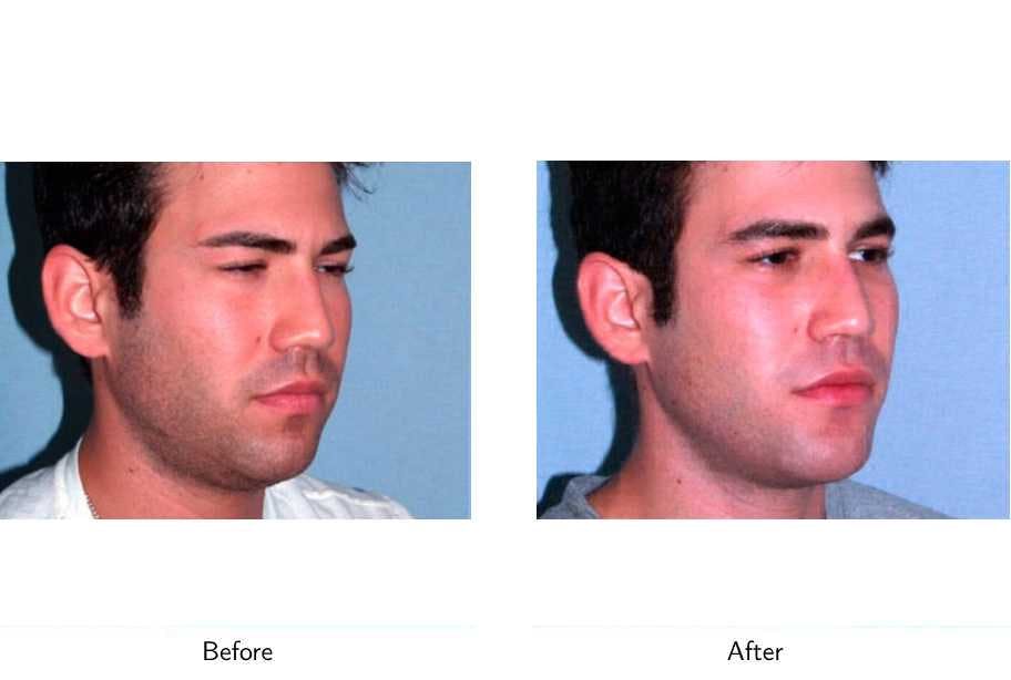 Chin Augmentation Before & After Gallery - Patient 64081154 - Image 3