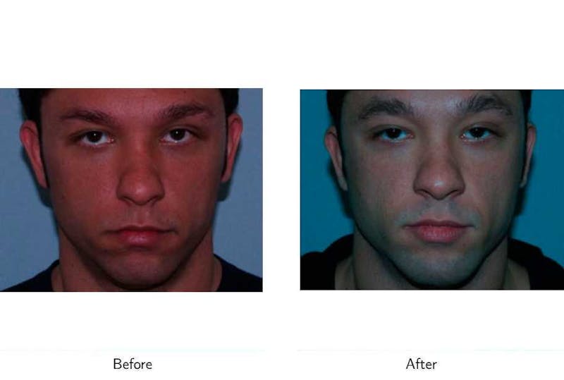 Chin Augmentation Before & After Gallery - Patient 64081156 - Image 1