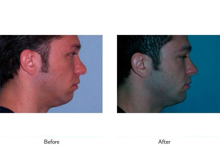 Chin Augmentation Before & After Gallery - Patient 64081156 - Image 2