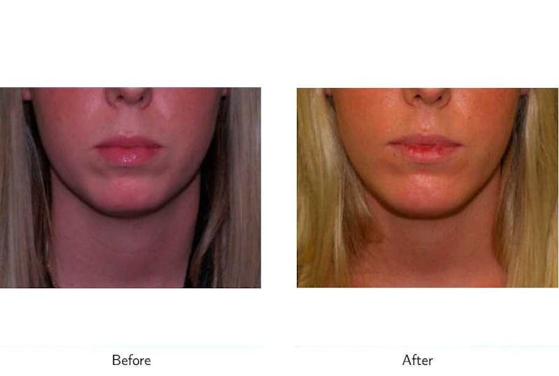 Chin Augmentation Before & After Gallery - Patient 64081159 - Image 1