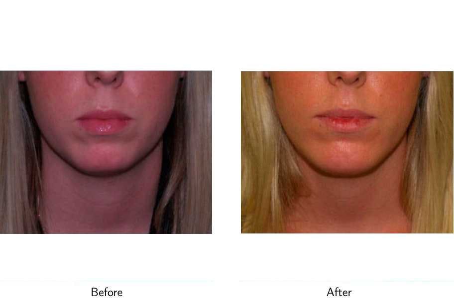 Chin Augmentation Before & After Gallery - Patient 64081159 - Image 1
