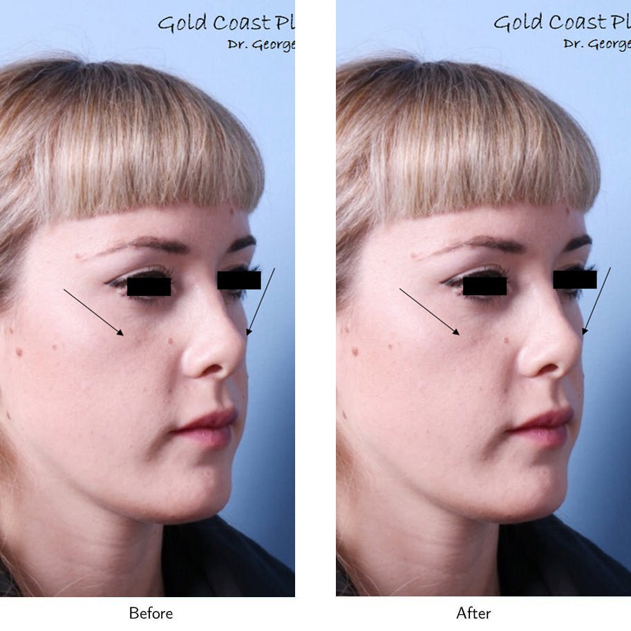 Non-Surgical Facelift Before & After Gallery - Patient 64081157 - Image 1