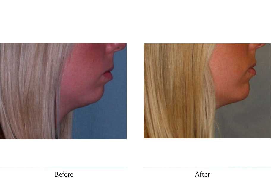 Chin Augmentation Before & After Gallery - Patient 64081159 - Image 2