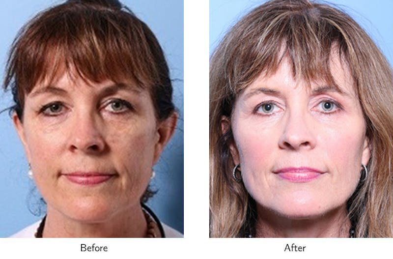 Non-Surgical Facelift Before & After Gallery - Patient 64081162 - Image 1