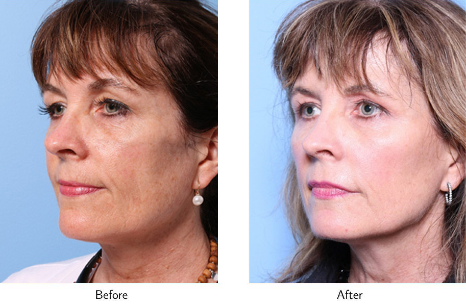 Patient 64081162 NonSurgical Facelift Before & After Photos Gold