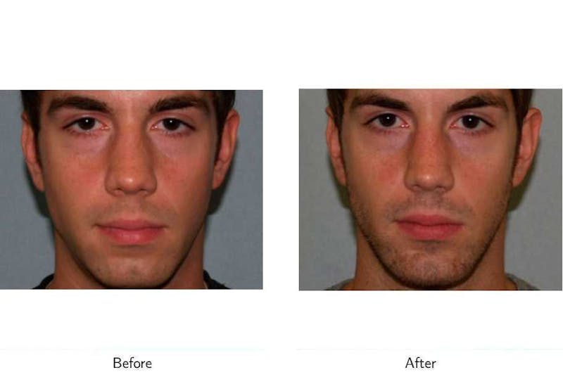 Chin Augmentation Before & After Gallery - Patient 64081161 - Image 1