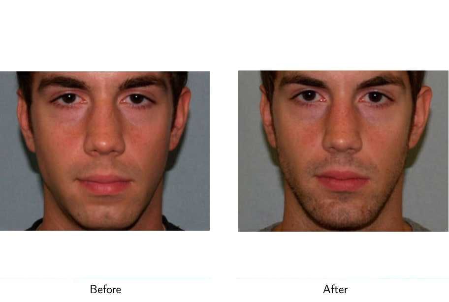Chin Augmentation Before & After Gallery - Patient 64081161 - Image 1