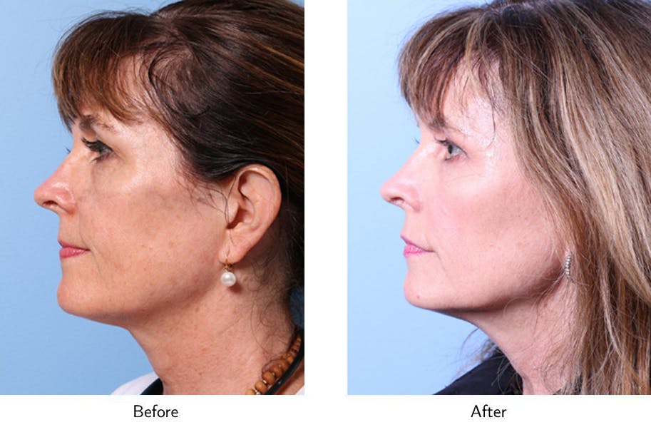 Non-Surgical Facelift Before & After Gallery - Patient 64081162 - Image 3