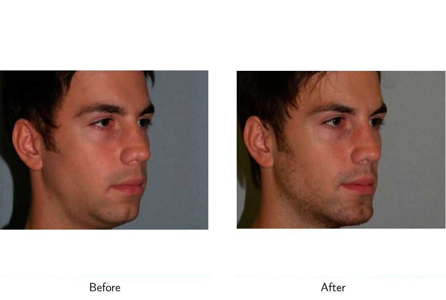 Chin Augmentation Before & After Gallery - Patient 64081161 - Image 3