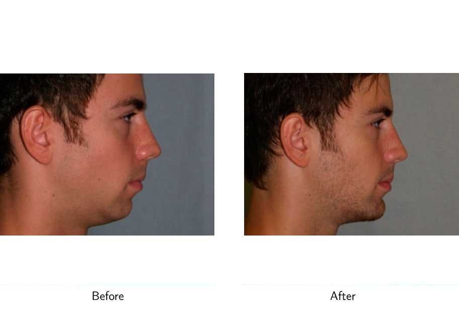 Chin Augmentation Before & After Gallery - Patient 64081161 - Image 2