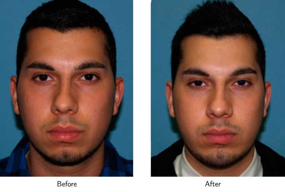 Chin Augmentation Before & After Gallery - Patient 64081163 - Image 2