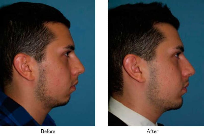 Chin Augmentation Before & After Gallery - Patient 64081163 - Image 1