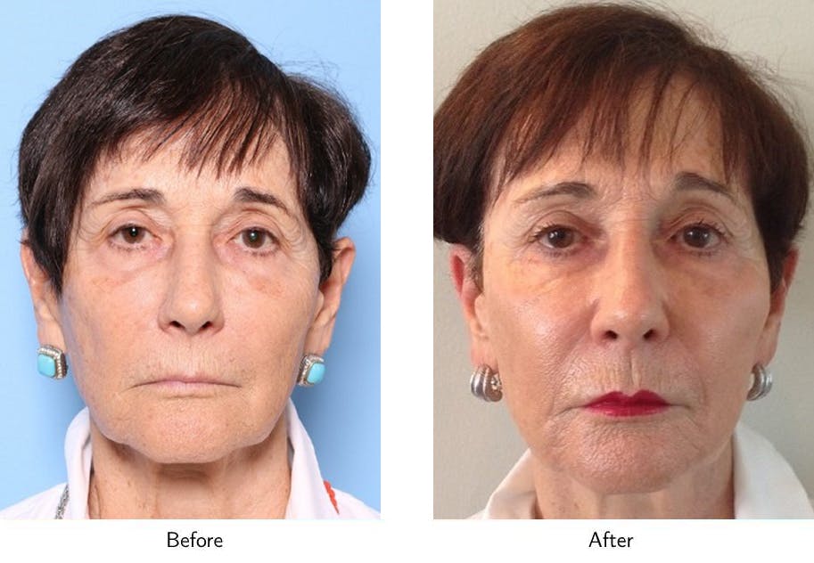 Non-Surgical Facelift Before & After Gallery - Patient 64081166 - Image 1