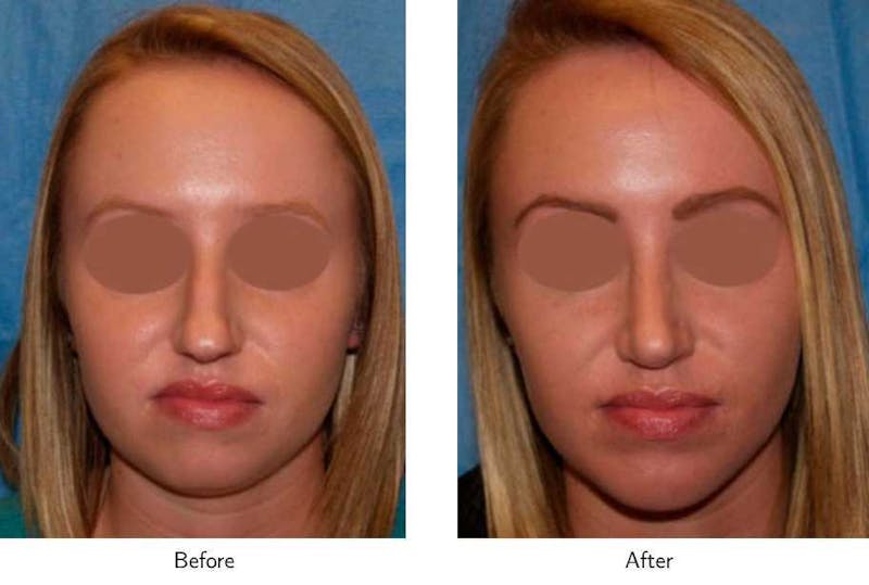Chin Augmentation Before & After Gallery - Patient 64081164 - Image 1
