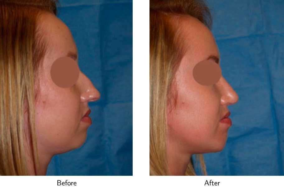 Chin Augmentation Before & After Gallery - Patient 64081164 - Image 2