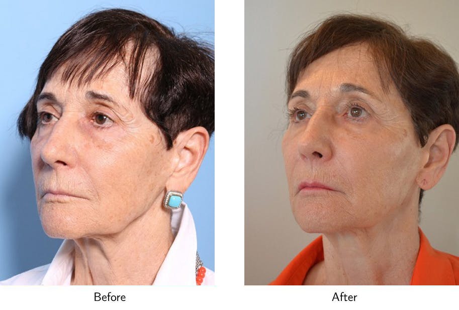 Non-Surgical Facelift Before & After Gallery - Patient 64081166 - Image 2
