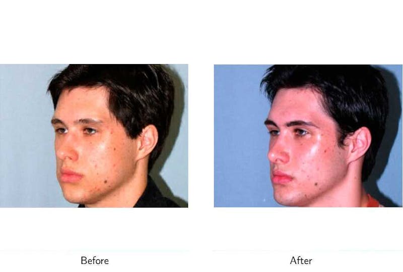 Chin Augmentation Before & After Gallery - Patient 64081165 - Image 1
