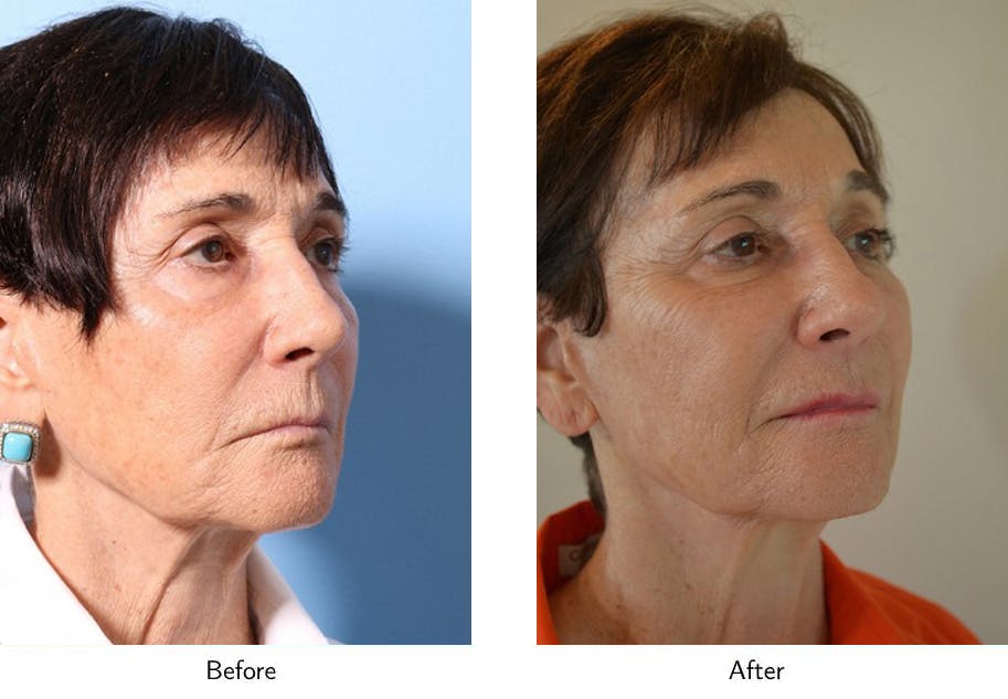 Non-Surgical Facelift Before & After Gallery - Patient 64081166 - Image 3
