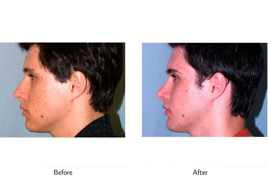 Chin Augmentation Before & After Gallery - Patient 64081165 - Image 2
