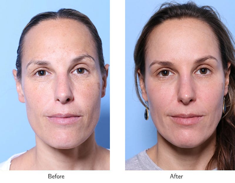 Facelift Before and After Photo Gallery