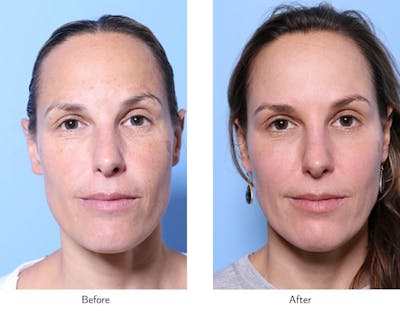 Non-Surgical Facelift Before & After Gallery - Patient 64081168 - Image 1