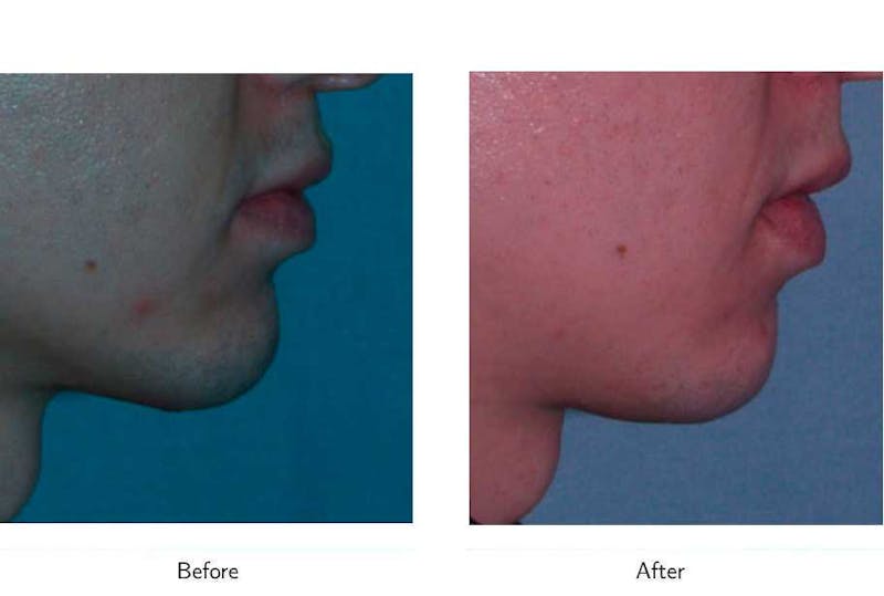 Chin Augmentation Before & After Gallery - Patient 64081167 - Image 1