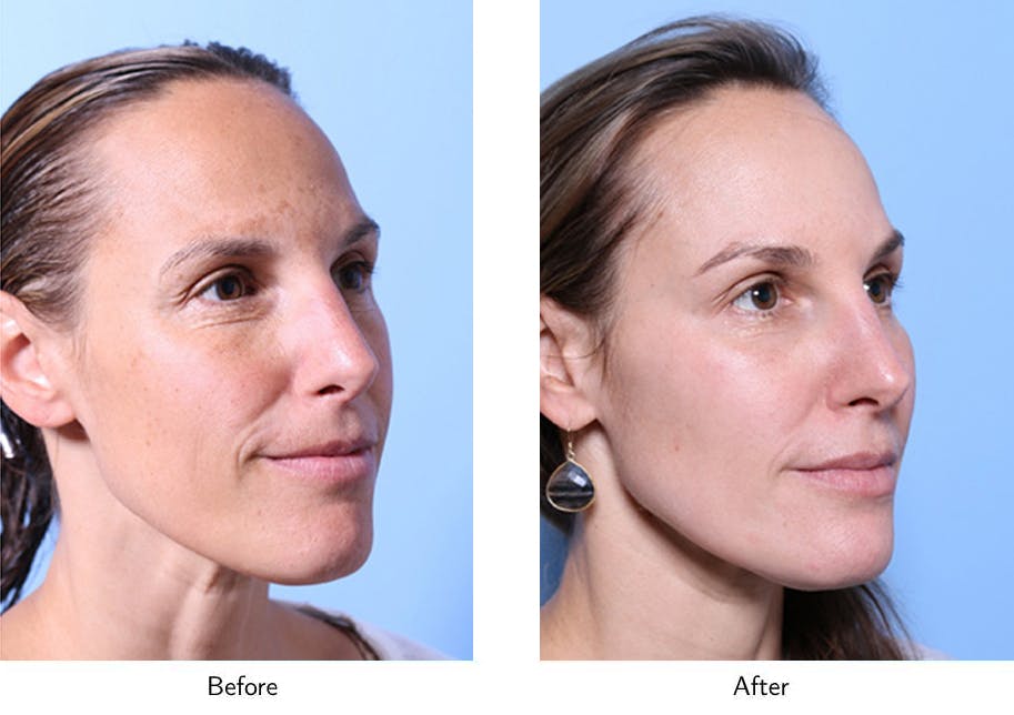 Non-Surgical Facelift Before & After Gallery - Patient 64081168 - Image 2