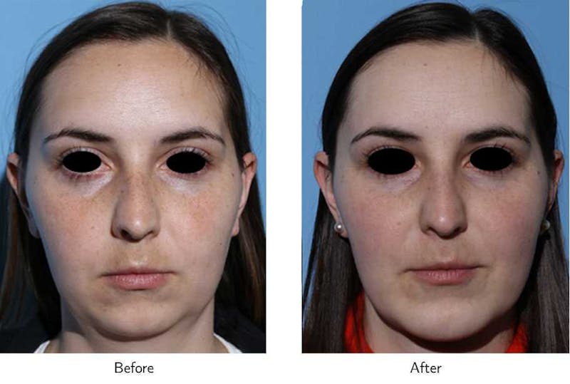 Chin Augmentation Before & After Gallery - Patient 64081169 - Image 1