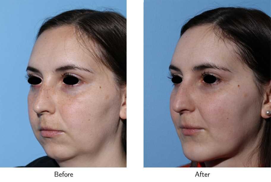Chin Augmentation Before & After Gallery - Patient 64081169 - Image 3