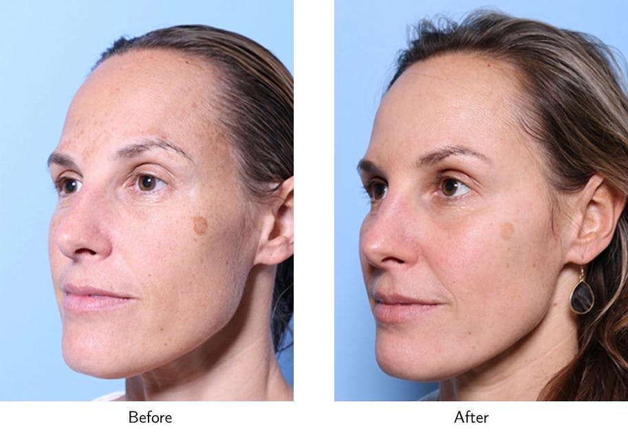 Non-Surgical Facelift Before & After Gallery - Patient 64081168 - Image 3